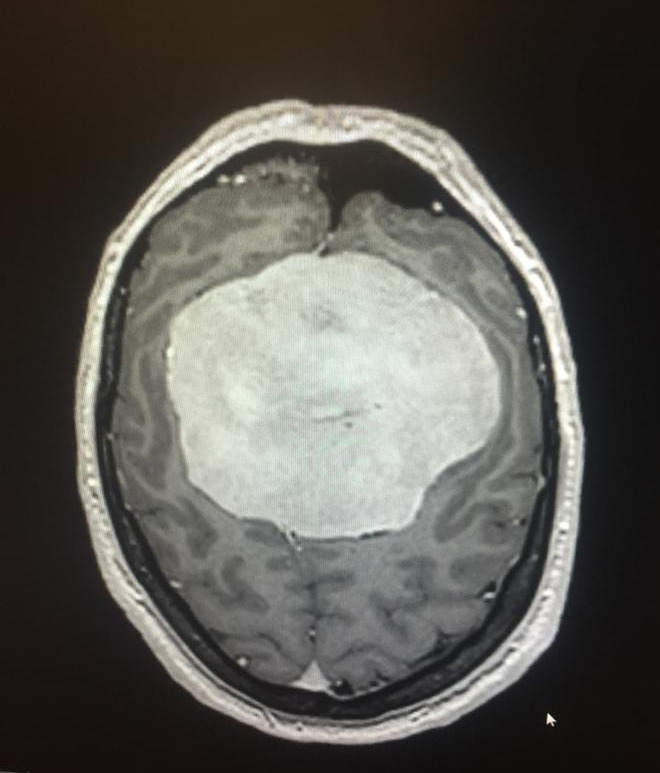 Brain tumour on brain scan