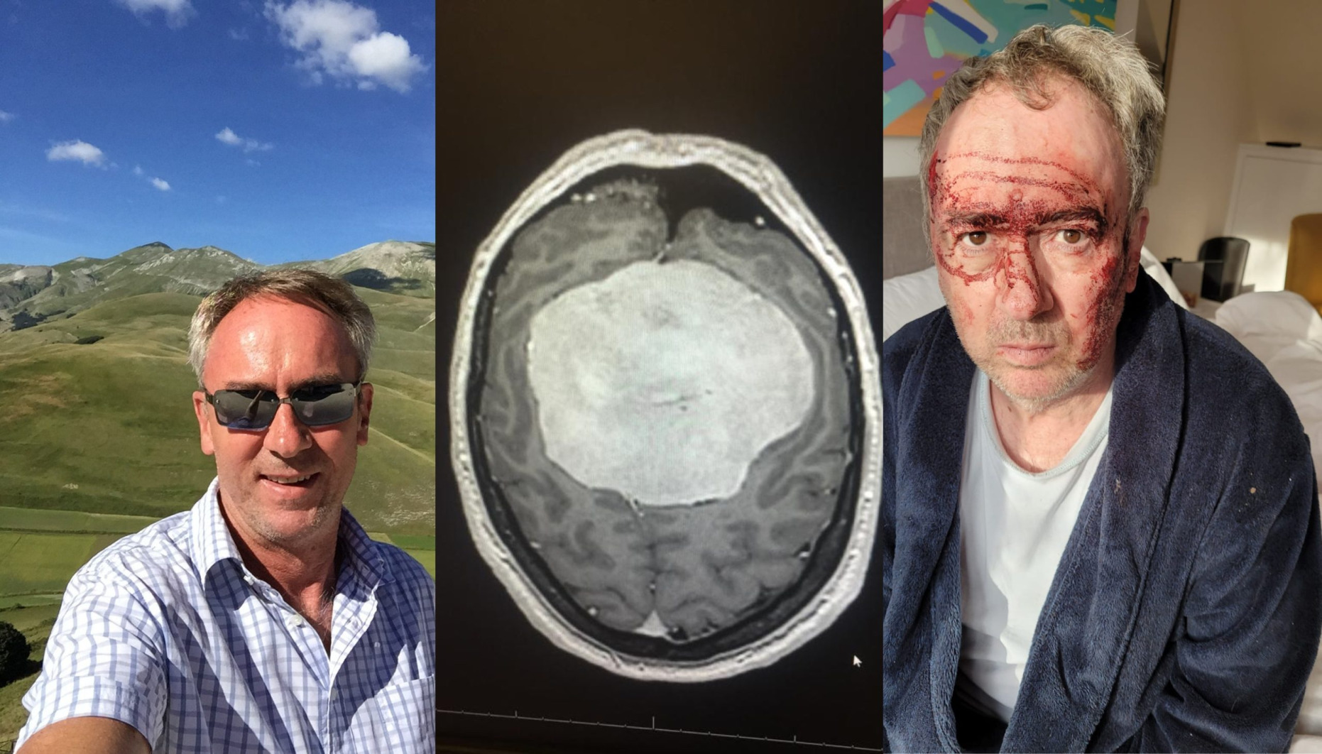 David, brain tumour