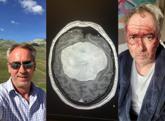 David, brain tumour